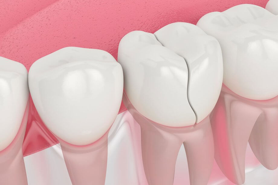 Can A Cracked Tooth Heal On Its Own?